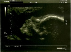 Ecografia 20 Semanas e 5 dias 